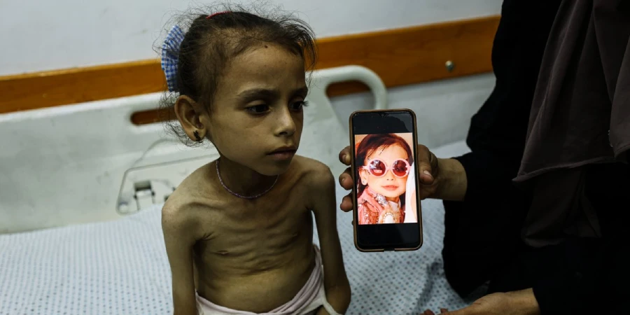 امدادی دعووں کے باوجود غزہ میں بھوک کا بحران برقرار، غذائی قلت میں اضافہ، عالمی ادارۂ صحت