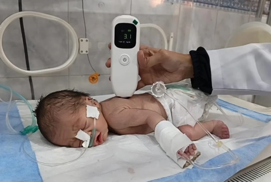 سول اسپتال کراچی میں نوزائیدہ بچوں کے پیلیا کی تشخیص کے لیے جدید مشین متعارف